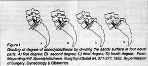 Grading of degree of spondylolisthesis - Copyright – Stock Photo / Register Mark