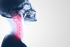 herniation xray - Copyright – Stock Photo / Register Mark