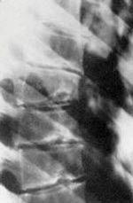 Scheuermann�s Disease: A Poorly Understood Abnormality of the Adolescent Spine - Copyright – Stock Photo / Register Mark