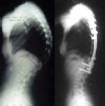 Scheuermann�s Disease: A Poorly Understood Abnormality of the Adolescent Spine - Copyright – Stock Photo / Register Mark