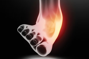 ankle sprains - Copyright – Stock Photo / Register Mark