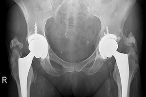 hip arthroplasty - Copyright – Stock Photo / Register Mark