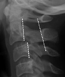 Pseudo subluxation - Copyright – Stock Photo / Register Mark