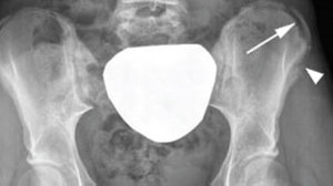 Iliac crest avulsion fracture - Copyright – Stock Photo / Register Mark