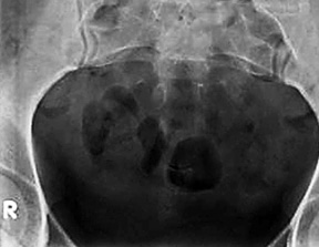 PA view of the coccyx - Copyright – Stock Photo / Register Mark