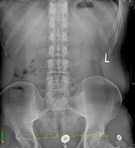 Barefoot standing X-ray - Copyright – Stock Photo / Register Mark